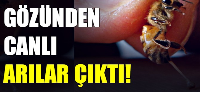 Gözünden canlı arılar çıktı