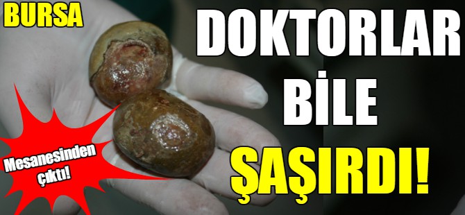 Mesanesinden yumurta büyüklüğünde taş çıktı