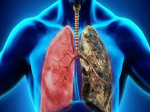 Akciğer kanseri hastaları desteklenmeli