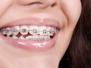 Ortodontik tedaviye ilgi