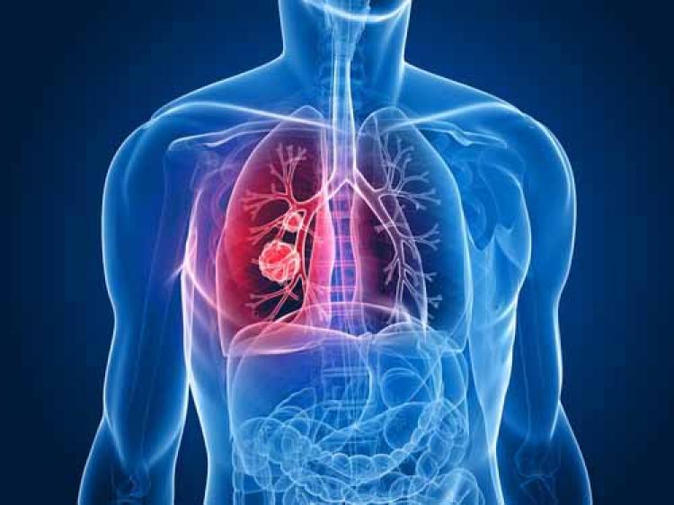 Akciğer kanserinde hedefe yönelik tedavi umudu