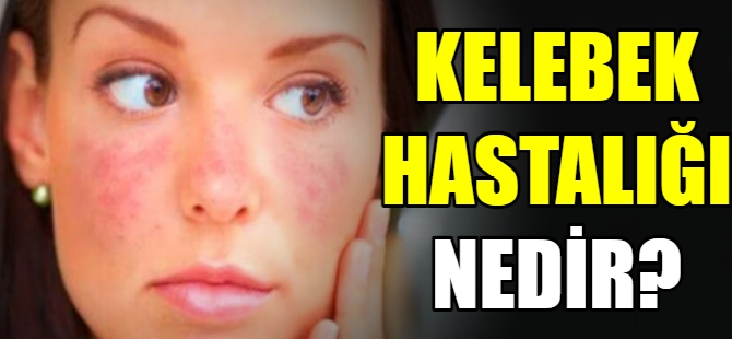 Kelebek hastalığı nedir?