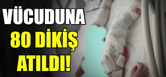 Vücuduna 80 dikiş atıldı
