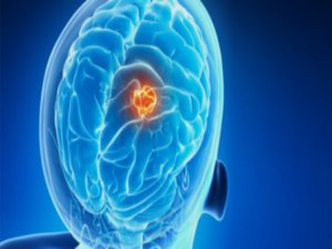 Beyin tümörünün belirtileri