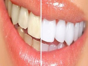Diş beyazlatma güvenilir mi?