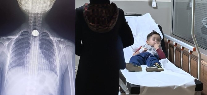 Yemek borusuna madeni para takıldı