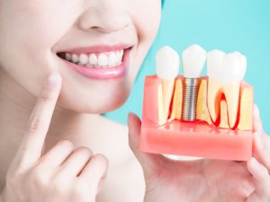 Diş implantları hakkında bilmeniz gereken 9 bilgi