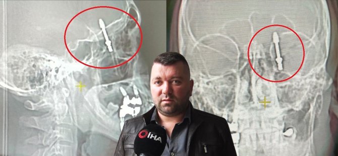 Bursa'da dişçiden korkunuç hata! İmplant hayatını kararttı