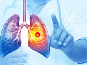 Her yıl 25 bin akciğer kanseri vakası önlenebilir! İşte hayat kurtaran 5 önlem...