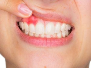 Dikkat! Kalp krizi riski diş etinden başlayabilir