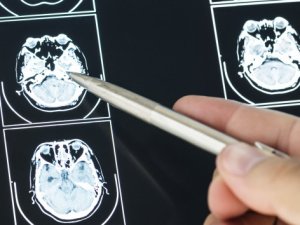 Dikkat! MS, kadınlarda daha erken yaşta başlıyor!