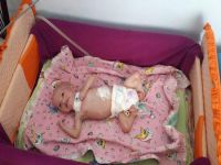 'Aslan Sendromlu' bebek, yaşam mücadelesini kaybetti