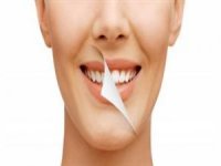 Diş kaybının 4 nedeni