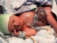 Bağırsakları dışarıda doğdu