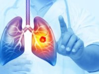 Her yıl 25 bin akciğer kanseri vakası önlenebilir! İşte hayat kurtaran 5 önlem...