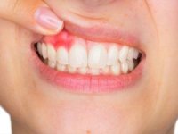 Dikkat! Kalp krizi riski diş etinden başlayabilir