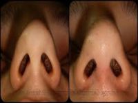 Burnundan ceviz büyüklüğünde taş çıktı